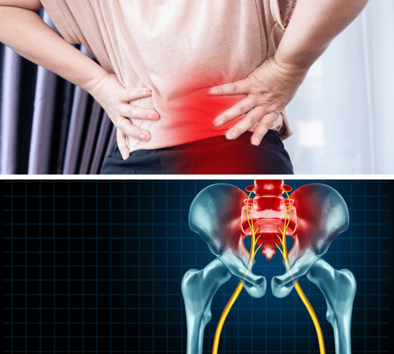 Unlock Relief: The Best Supplement for Sciatica to Ease Your Pain Naturally