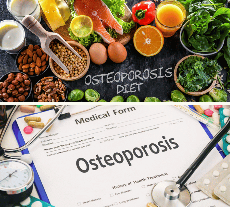 The Best Supplement for Osteoporosis: Proven Nutrients to Prevent Bone Loss